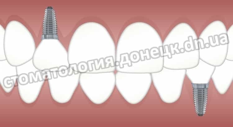 имплантация зубов Донецк зубные импланты в Донецке